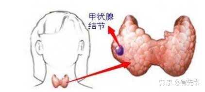 甲状腺结节钙化啥意思？钙化有什么危害？